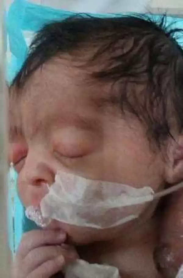 Baby Girl Born With Her Heart Outside Her Chest [Photos]